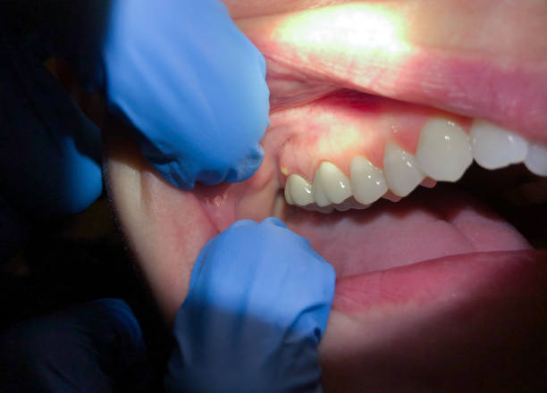 Best Lost Filling or Crown Replacement in Chico, TX